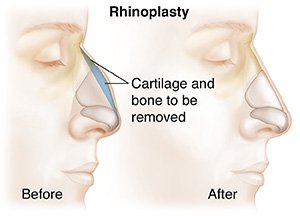 Nasal Rhinotomy Nose Reshaping - Jeffrey Ptak, M.D. | Silhouette Surgical Spa